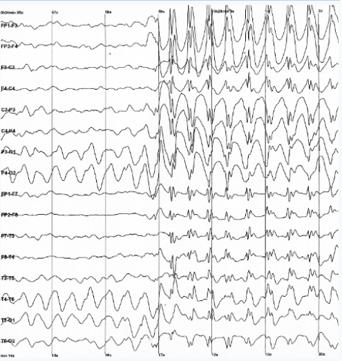 Typical EEG